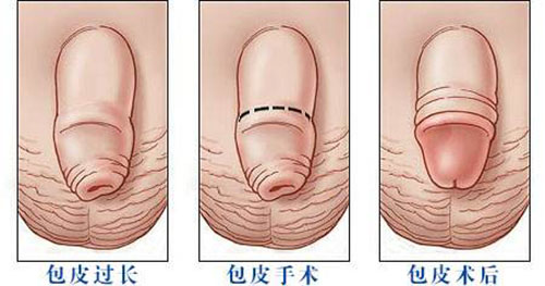 包皮怎样过长